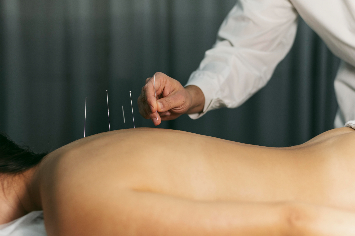 Exploring the Benefits of Dry Needling in Physiotherapy in Dubai
