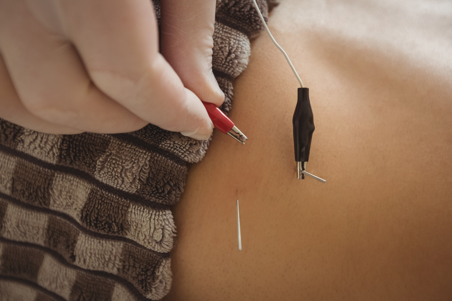 Dry Needling and How It Is Incorporated into Physical Therapy
