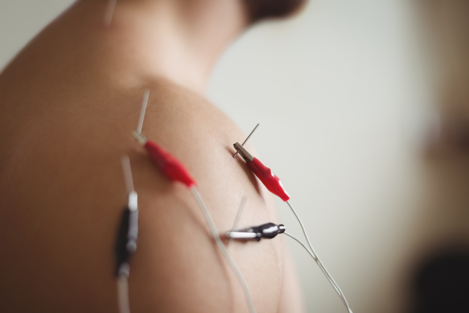 Dry Needling Physiotherapy The Ultimate Pain Relief Solution