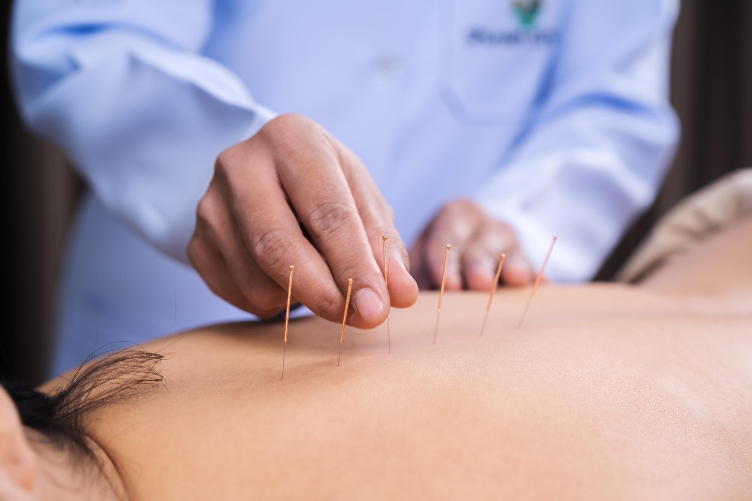 Dry Needling What It Is, How It Works and Whether It Helps