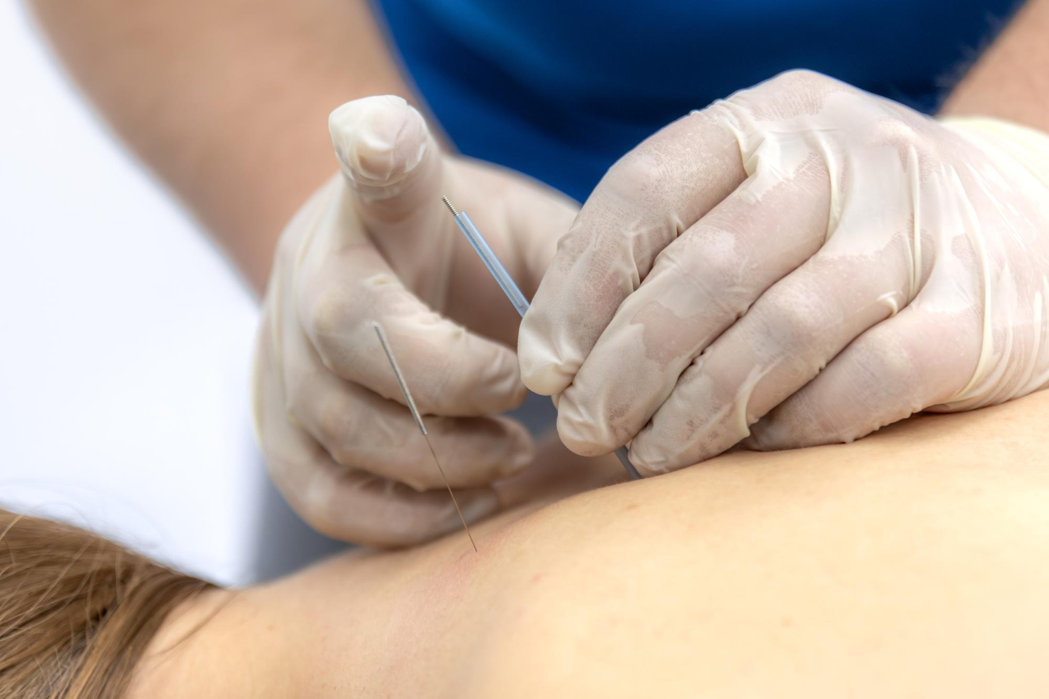 Understanding Dry Needling Therapy How It Works and Who Can Benefit