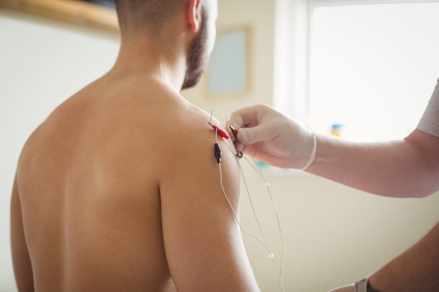 Dry Needling What It Is, How It Works and Whether It Helps