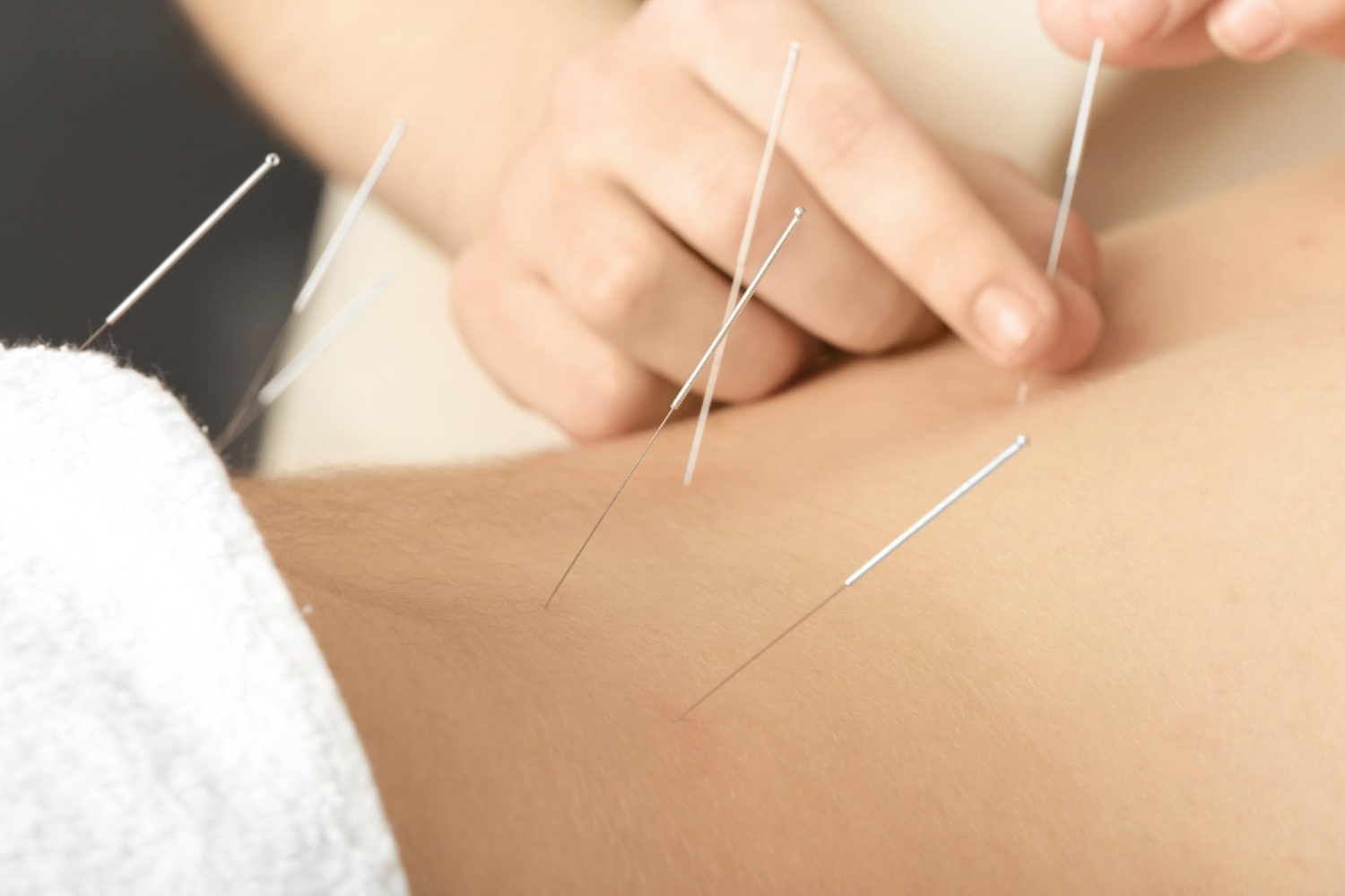 Dry Needling Therapy Benefits, How It Works, and What to Expect