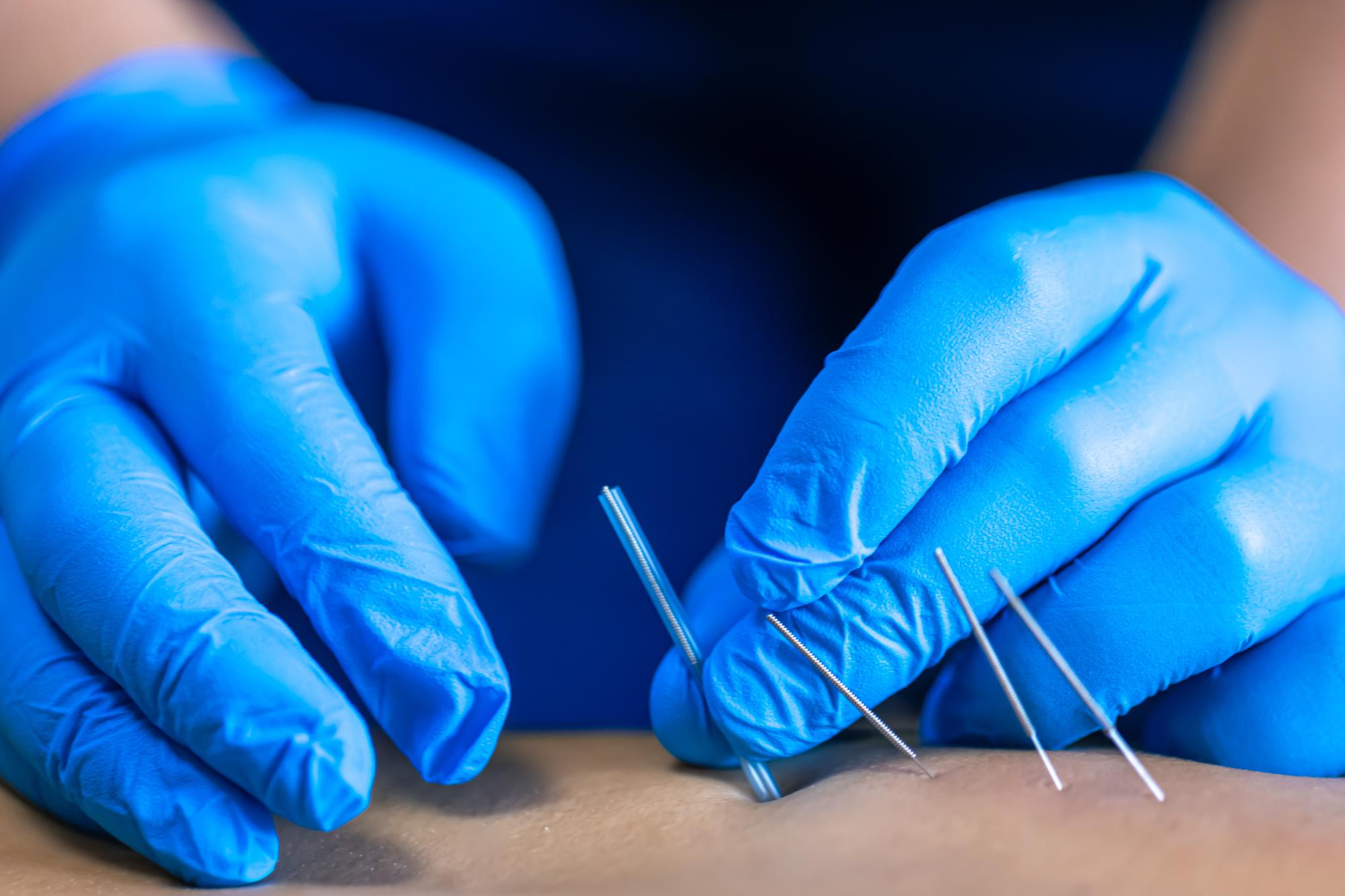 How Dry Needling Works From Pain Relief to Enhanced Mobility